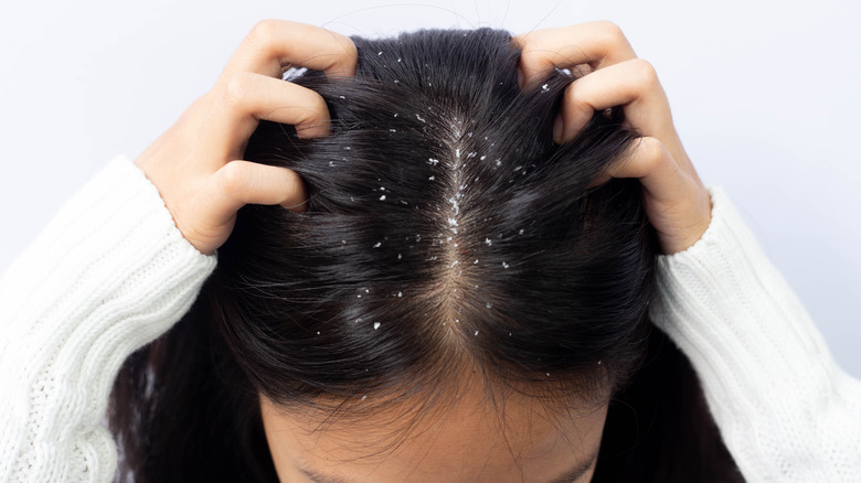 woman itching head with dandruff