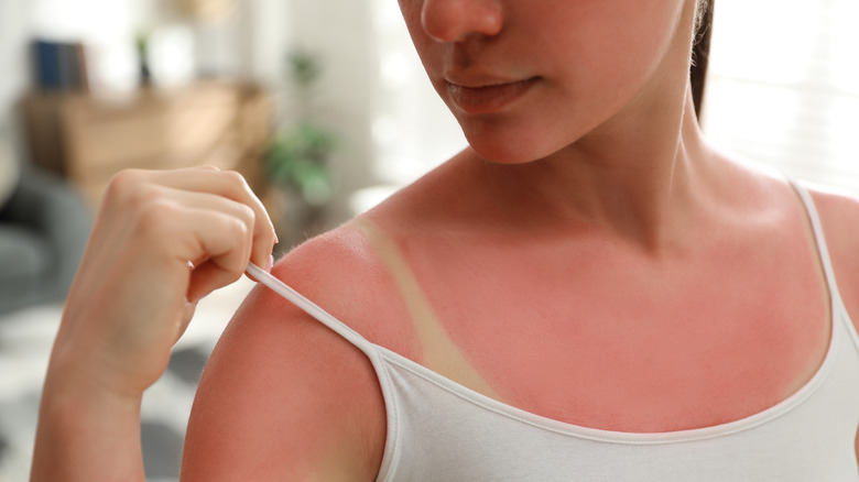 woman with sunburned skin