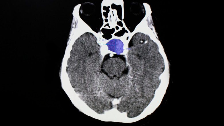 MRI of brain with pituitary tumor