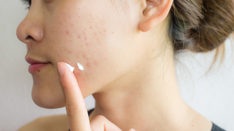 woman putting cream on pimples