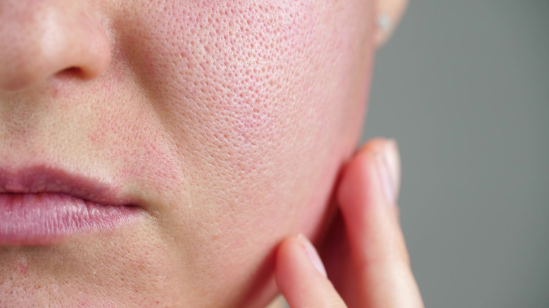 Enlarged pores on face