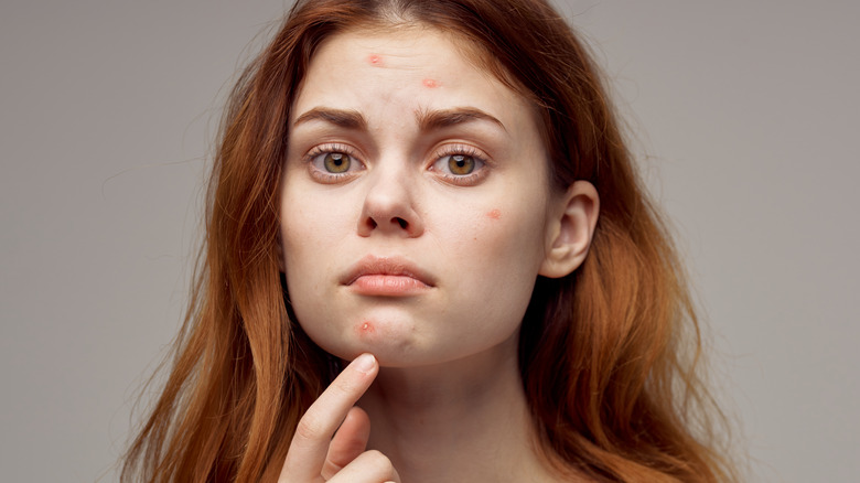 Young woman with acne