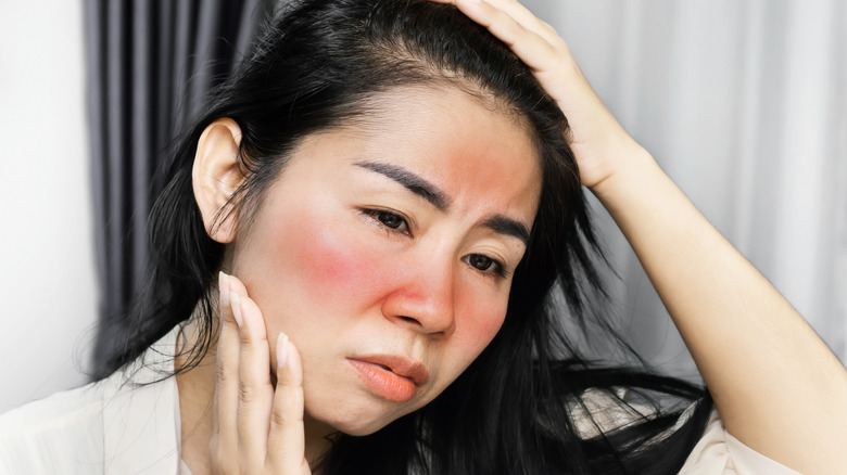 Woman with sunburn on face