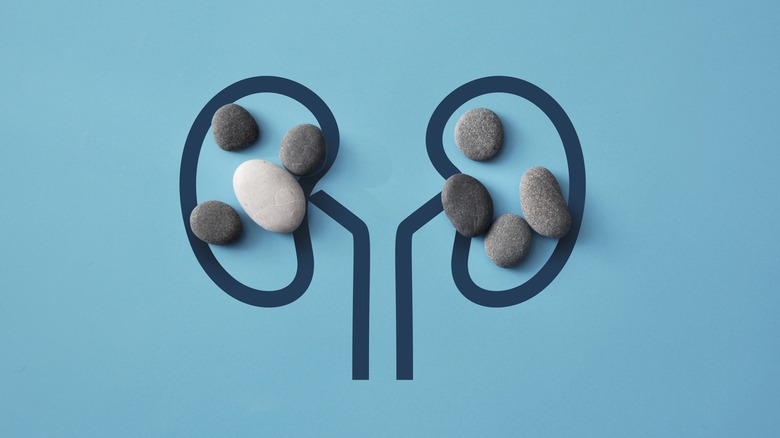 illustration of kidney with stones on it
