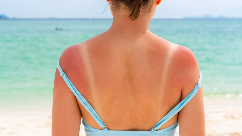 woman with sunburned back