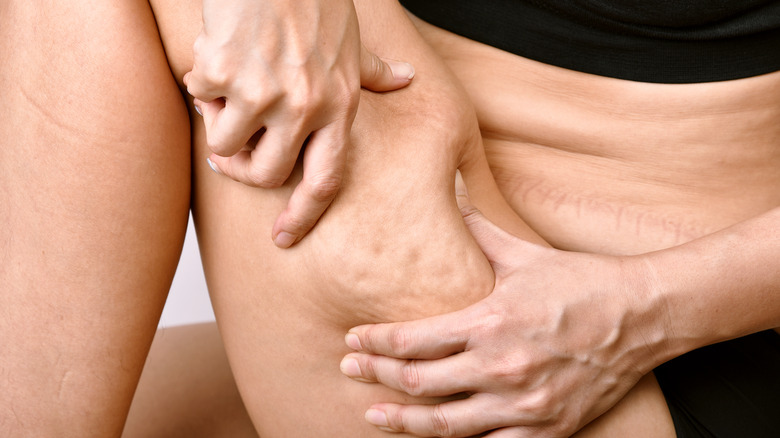 woman pinching cellulite on thigh