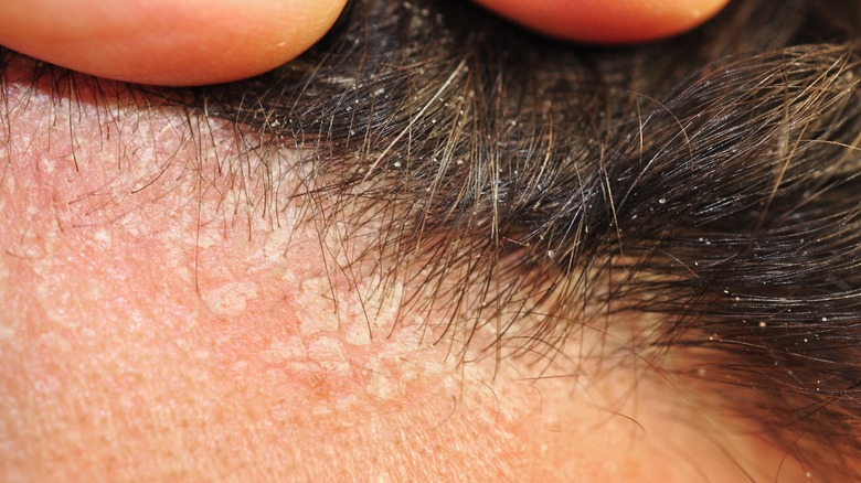 eczema on the scalp