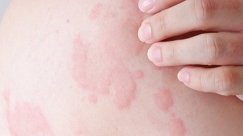 image of woman with hives