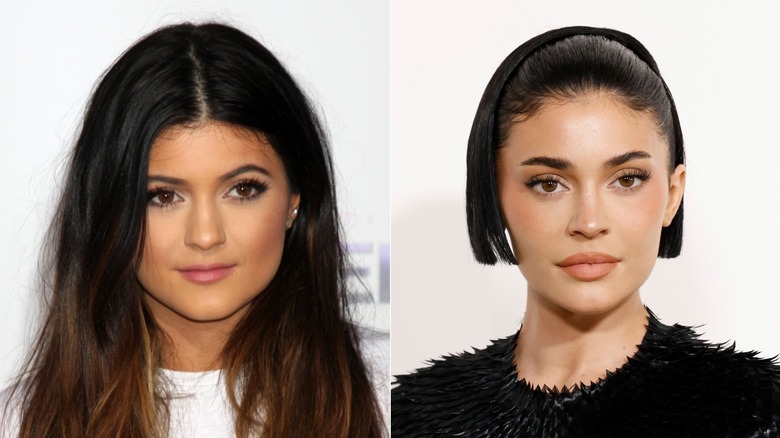 Kylie Jenner before and after lip fillers