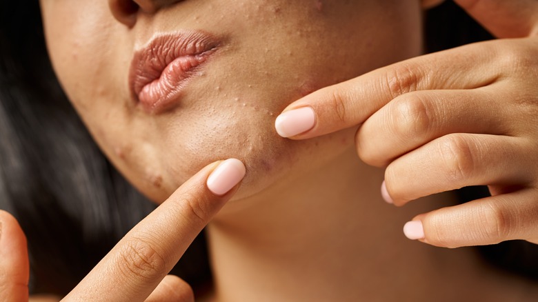 Woman picking at acne skin