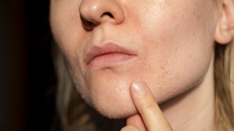 Woman with damaged skin barrier