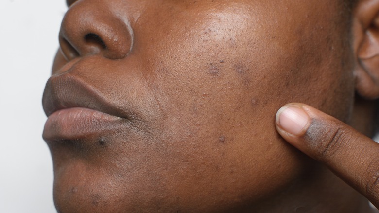 Woman with dark hyperpigmentation