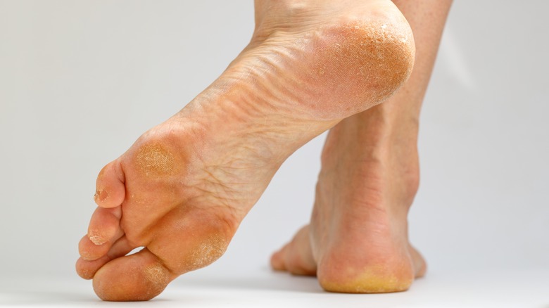 Feet with callus