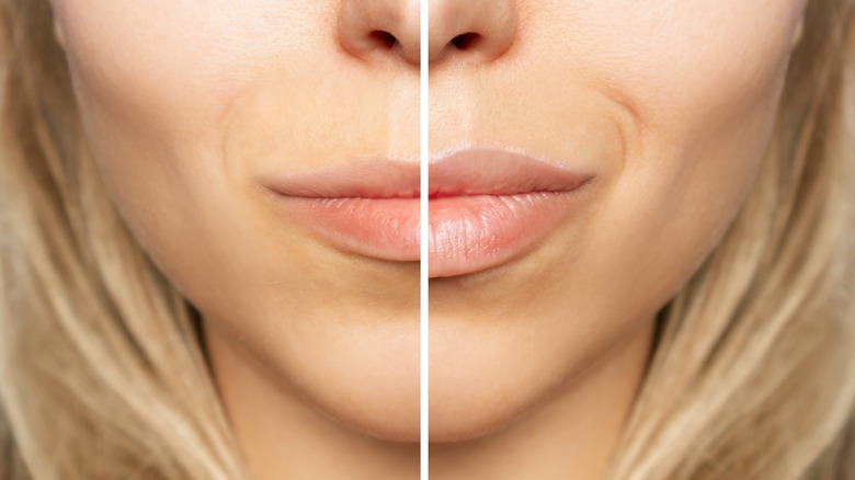 Before and after lip filler