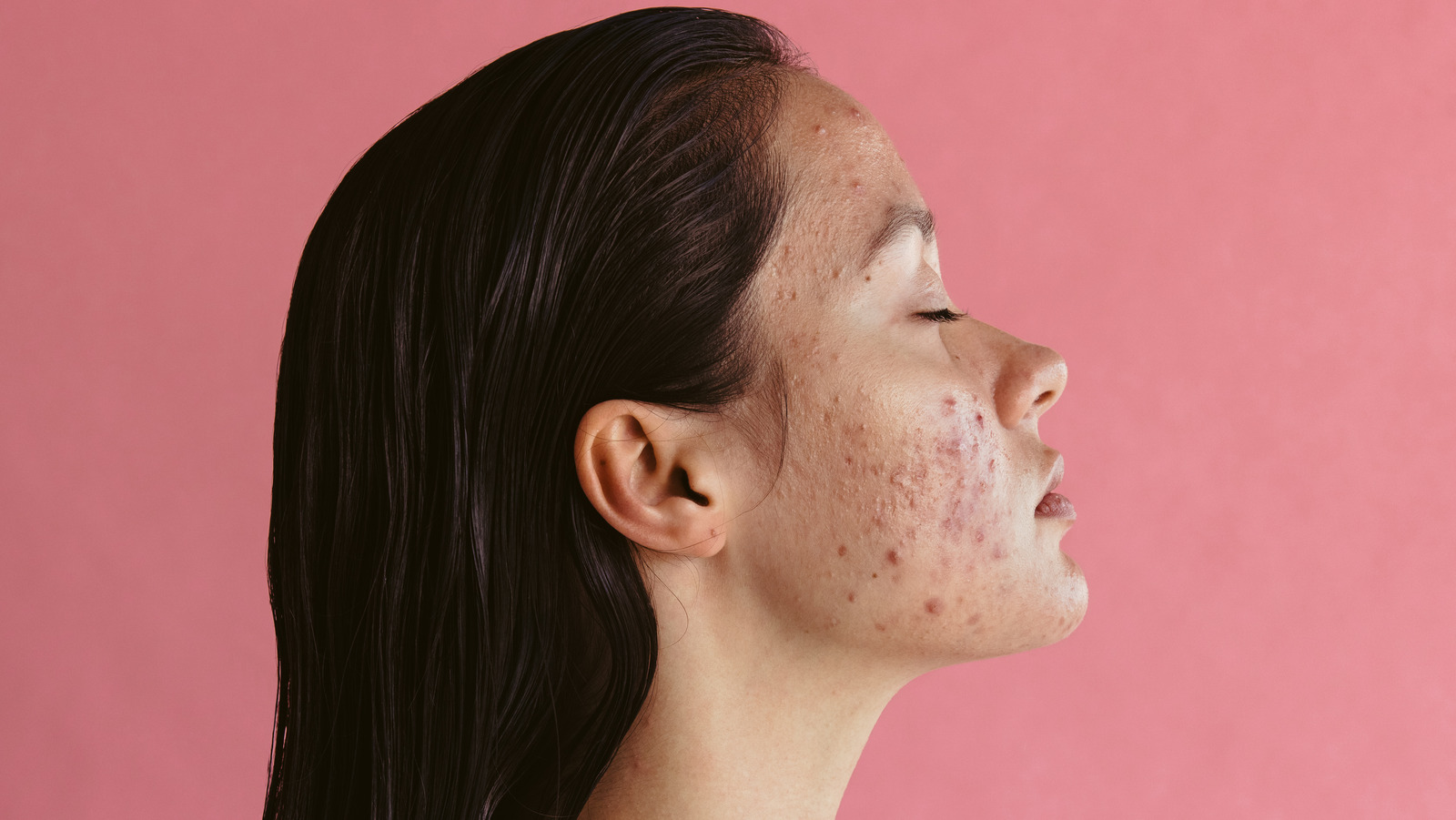 acne-can-take-an-emotional-toll-on-you-here-s-how-to-stop-it