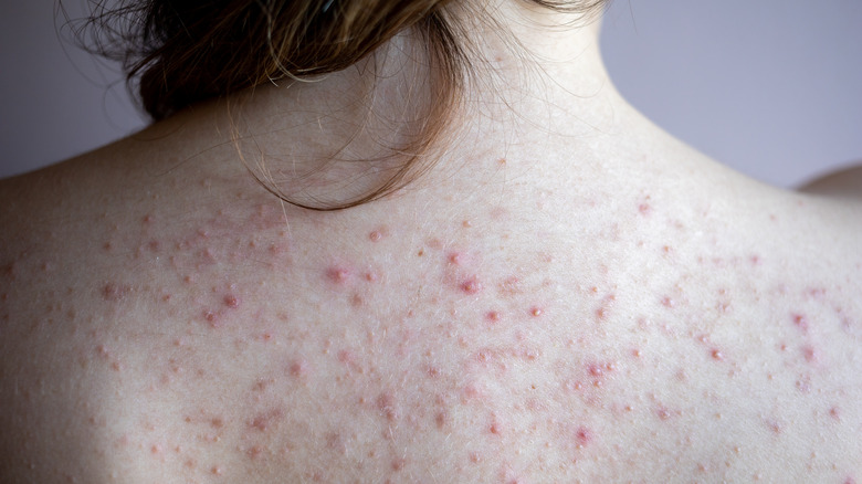 Young woman with back acne