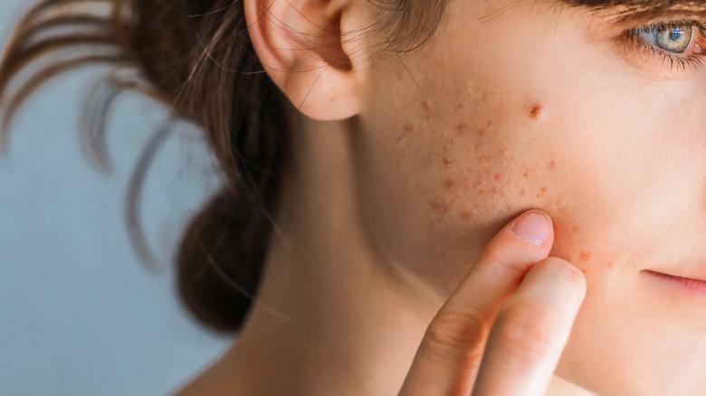 Woman with acne on her cheeks