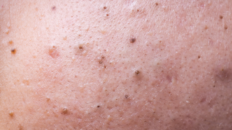 Skin with blackheads