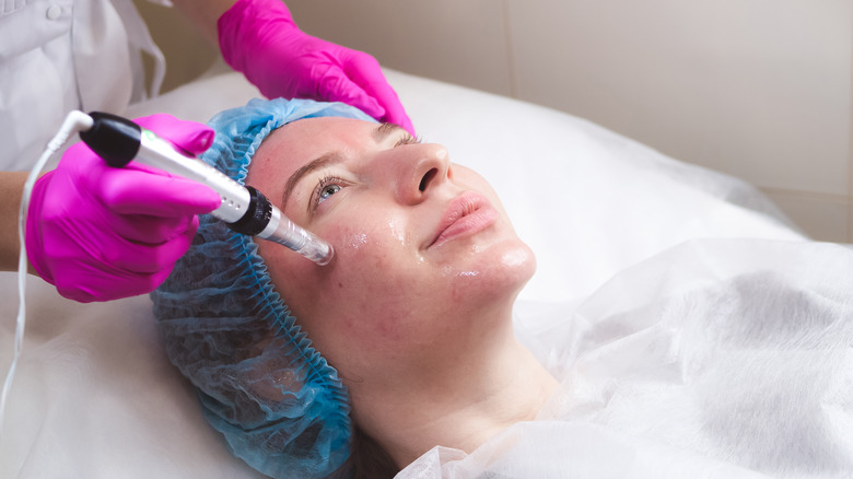 Microneedling procedure on acne-prone area