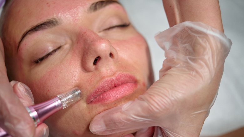 Microneedling procedure around lips