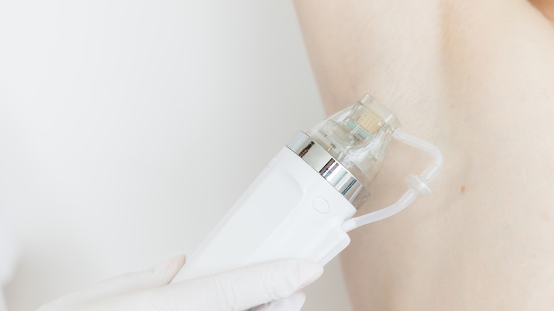 Microneedling procedure on armpit