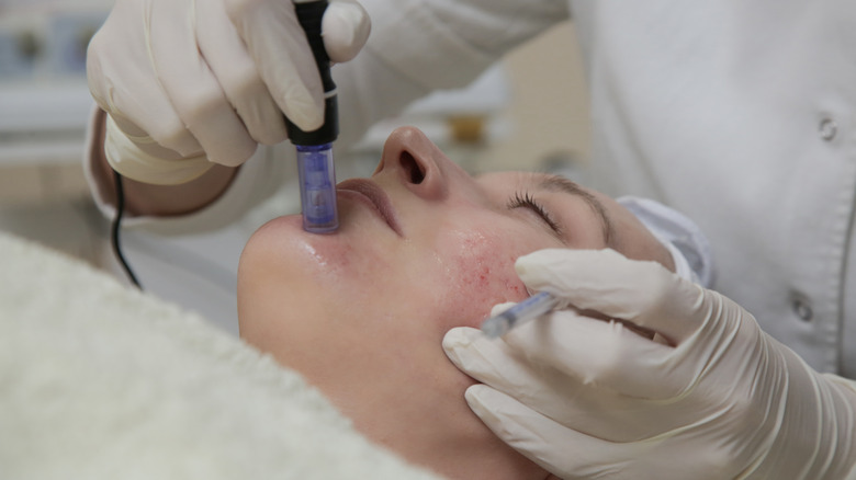 Microneedling procedure on rosacea