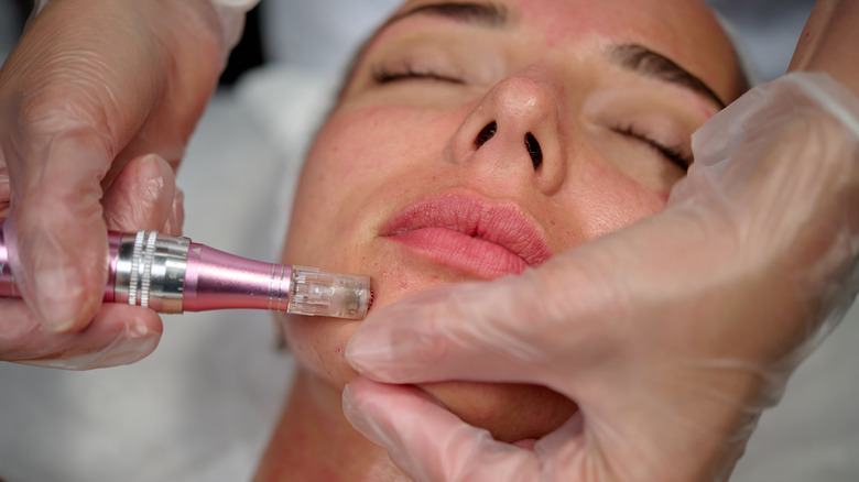 Microneedling procedure on chin