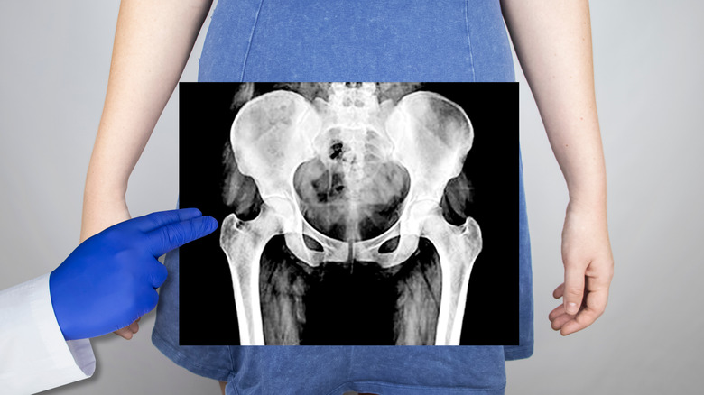 x-ray of woman's pelvis and hips