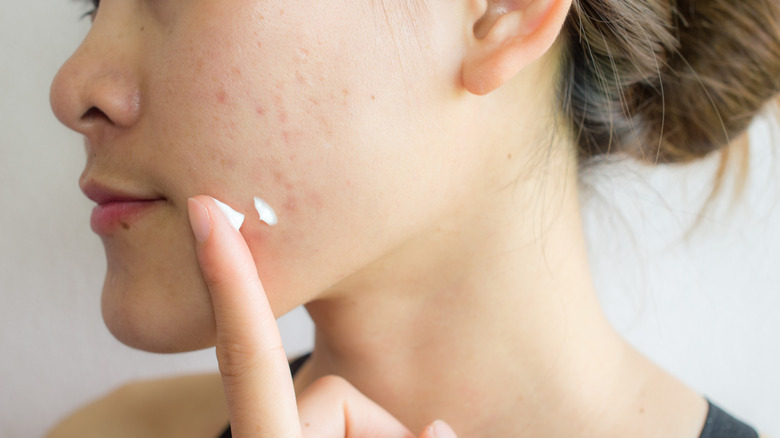 Applying acne medicine to face