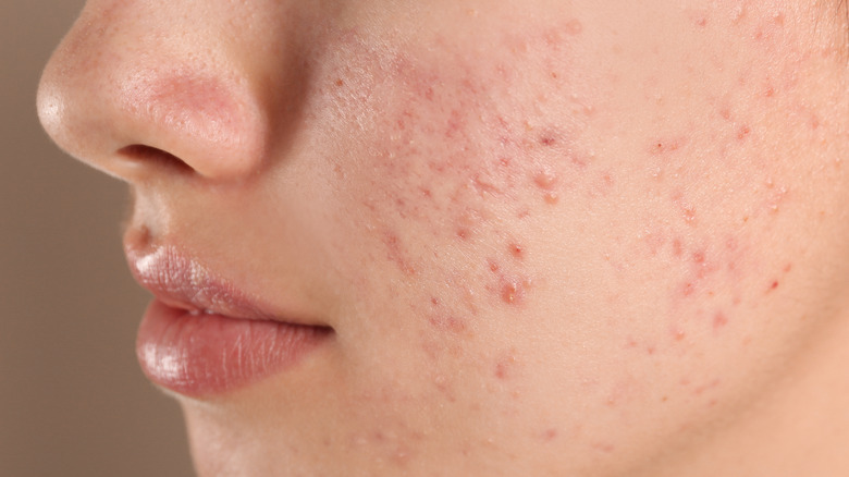 female acne skin