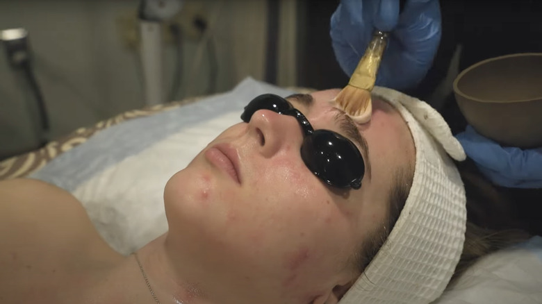 woman with acne getting hydrafacial