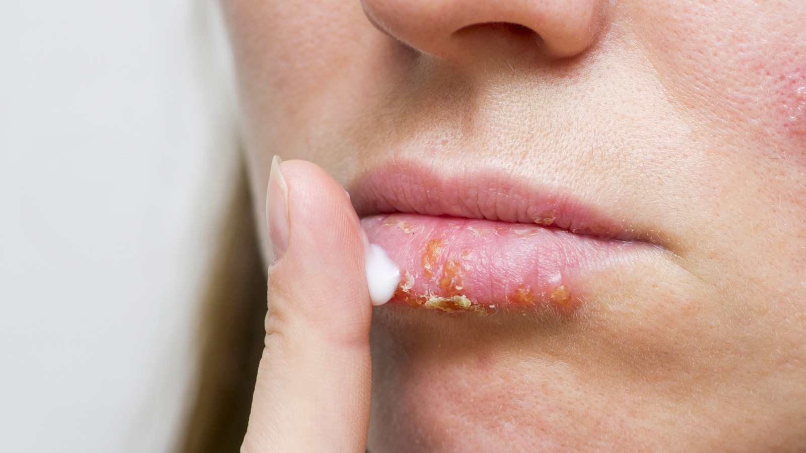 Is It Chapped Lips Or A Cold Sore Here s How To Tell How To Treat 