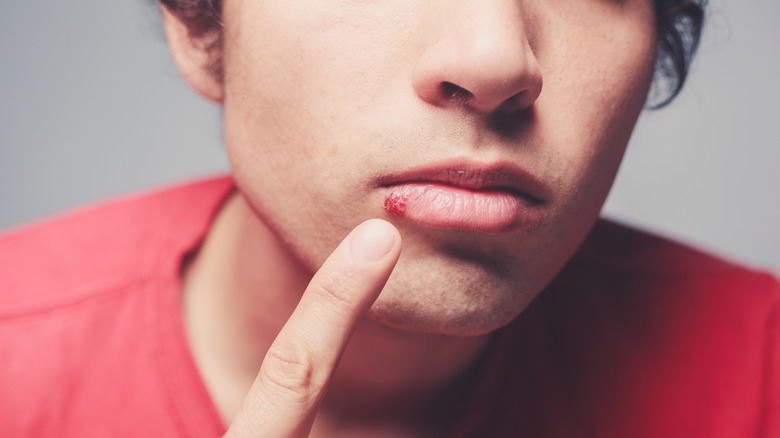 Man pointing to cold sore