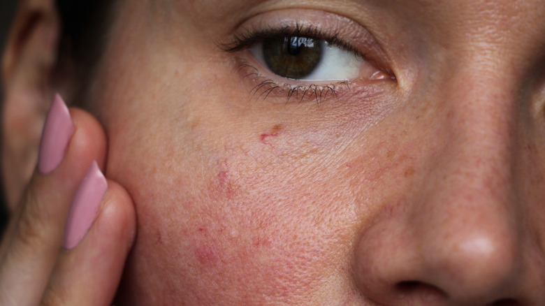woman with irritated acne-prone skin