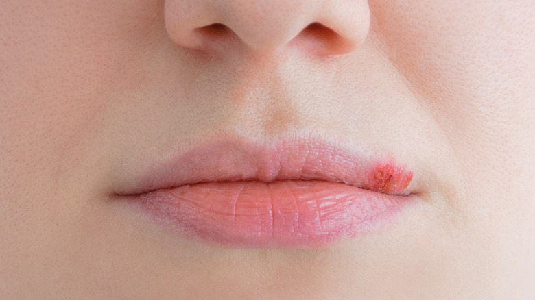 Model with cold sore on lip