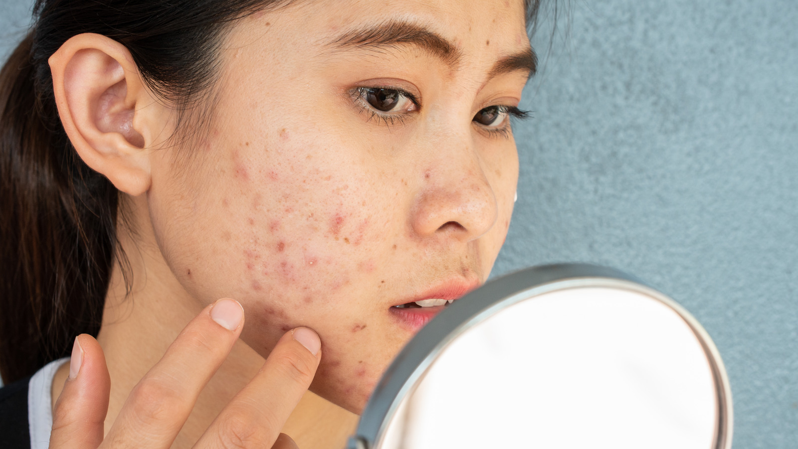 bad-news-some-people-are-more-acne-prone-because-of-genetics