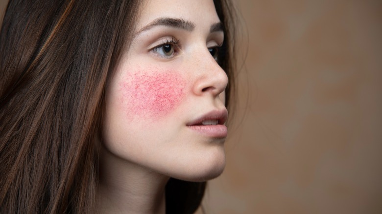 Woman with rosacea on cheeks