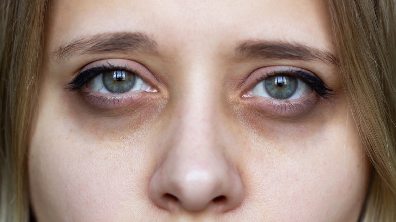 Woman with dark circles under eyes