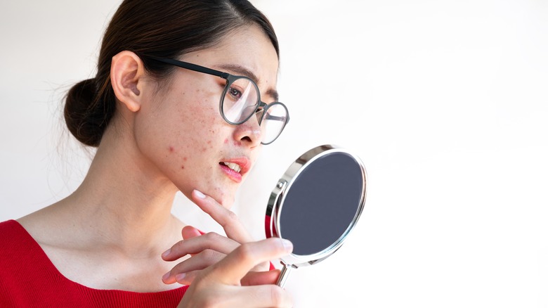 Woman with acne looking at herself in a mirror