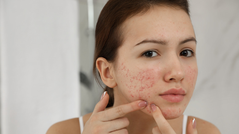 Woman picking at acne