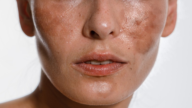 female melasma