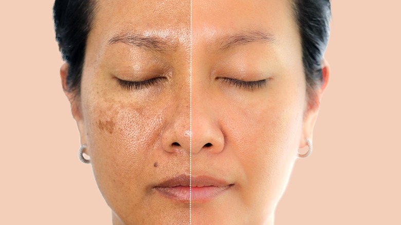 female melasma before after treatment