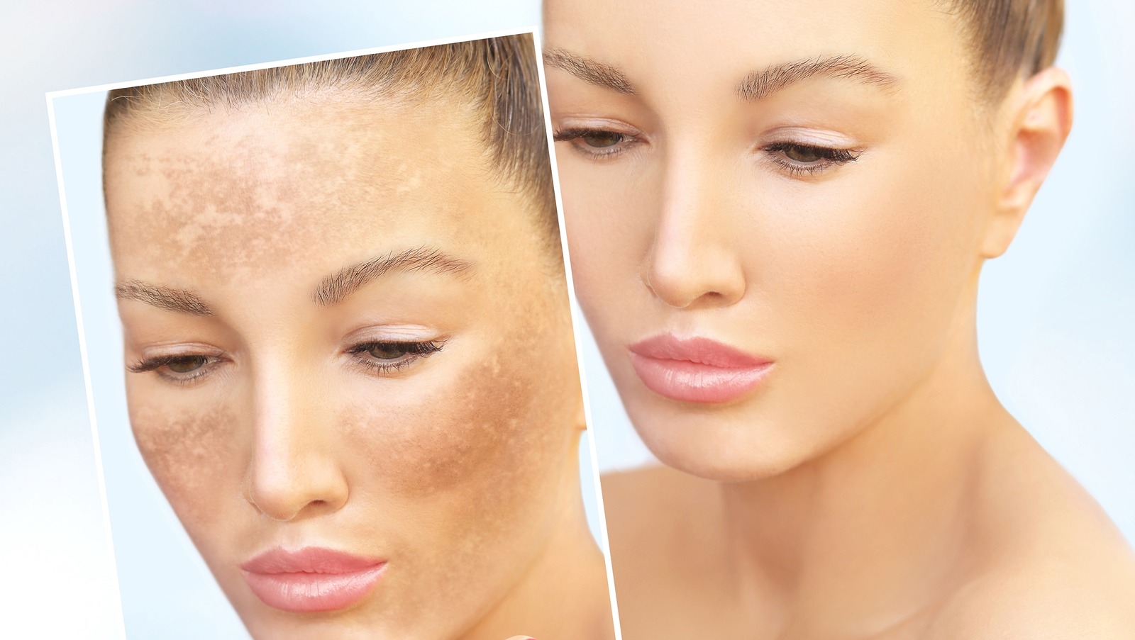 body-hyperpigmentation-what-is-it-and-why-does-it-happen