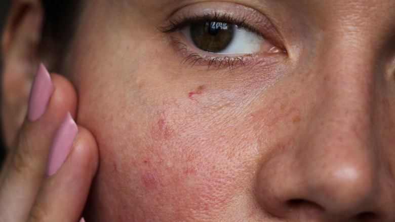 woman with broken facial capillaries