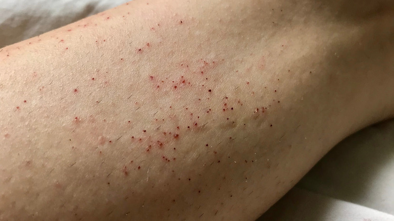 razor burn on person's leg 