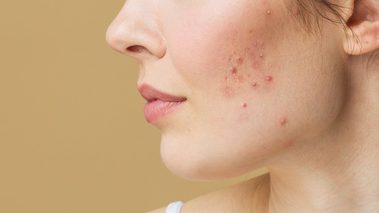 close up of woman with acne