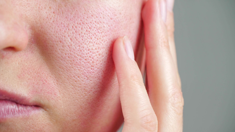 woman's enlarged pores on cheek