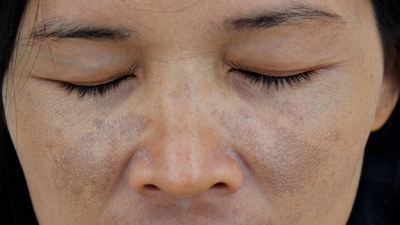 facial melasma