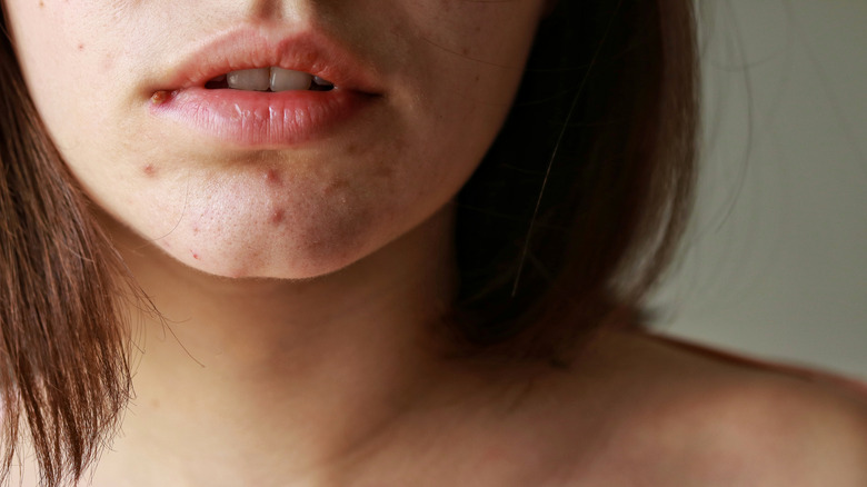woman with acne problem on lips
