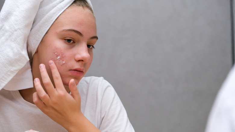 young woman treating acne